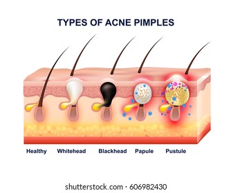 Colored skin acne anatomy composition with types of acne pimples before and after vector illustration