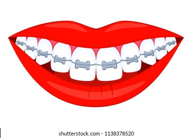 Colorful cartoon healthy smile in braces. Achieving beautiful smile concept. Dental care vector illustration for icon, sticker, label, badge, certificate, leaflet or banner decoration