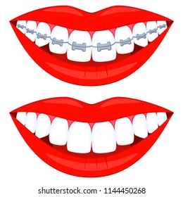 Colorful cartoon teeth aligning elements set. Before and after toothy smile with braces. Achieving beautiful smile concept. Dentalcare vector illustration for icon, label, badge decoration