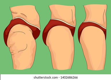 Colorful illustration of woman cellulite