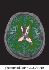 colorful mri of the brain of an adult male on a black background