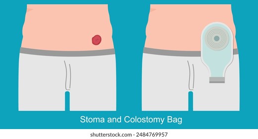 Una colostomía es un procedimiento quirúrgico que cambia la trayectoria del desperdicio de alimentos a través de sus intestinos con una colostomía, se caga en una bolsa de colostomía, Ilustración vectorial.