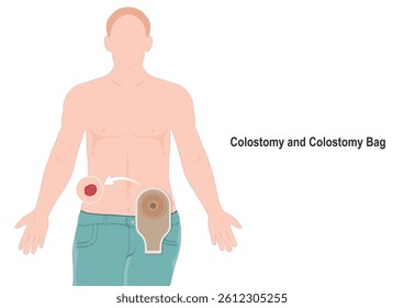 A colostomy is a surgical procedure that changes the trajectory of food waste through bowels with a colostomy, poop into a colostomy bag. Medical health care, vector illustration.