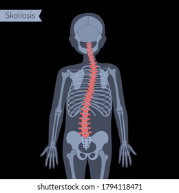 Combined Scoliosis In Child Body. XRay Flat Vector Illustration.Spine, Backbone, Joint And Skeleton Anatomy In Boy Silhouette. Orthopedic Poster. Medical Banner. Exam In Spinal Pain Center, Clinic.