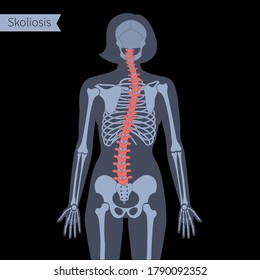 Coliosis combinada en el cuerpo femenino. Ilustración vectorial plana XRay. Anatomía de columna vertebral, espina dorsal, articulación y esqueleto en la silueta de mujer. Afiche ortopédico. Cartel médico. Examen en centro de dolor medular, clínica