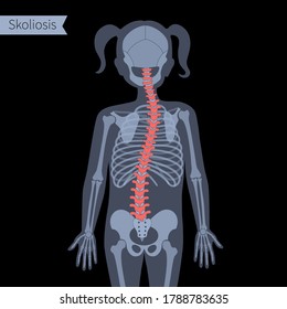 Combined Scoliosis In Girl Body. XRay Flat Vector Illustration. Spine, Backbone, Joint And Skeleton Anatomy In Child Silhouette. Orthopedic Poster. Medical Banner. Exam In Spinal Pain Center