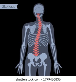 Combined scoliosis in human body. XRay flat vector illustration. Spine, backbone, joint and skeleton anatomy in man silhouette. Orthopedic poster. Medical banner. Exam in spinal pain center.