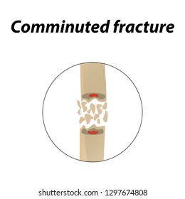 Comminuted fracture Bone. Infographics. Vector illustration on a lined background.