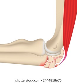 Fractura conminuta de la articulación del codo. Ilustración 3D de los huesos y músculos del brazo. Afiche médico, Ilustración vectorial