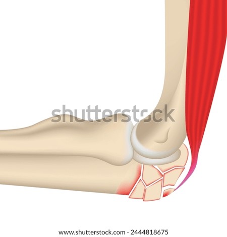 Comminuted fracture of the elbow joint. 3D illustration of the bones and muscles of the arm. Medical poster, vector illustration