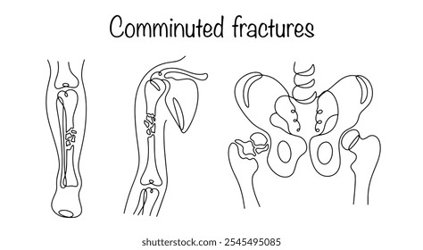 Comminuted fractures. Damage to the bone, in which its integrity is disrupted and fragments are formed. Hand-drawn illustrations of bone fractures resulting in splinters. Vector illustration.