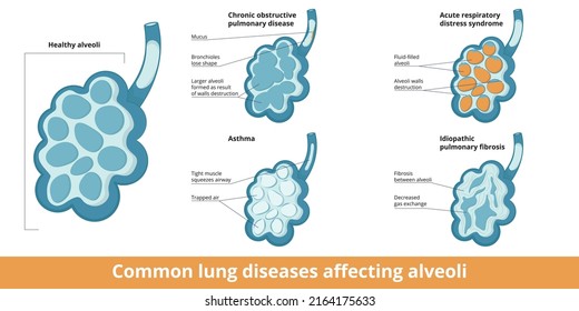 Common Alveoli Damages. Differences Between Changes Caused By Lung Diseases: Chronic Obstructive Respiratory Disease, Asthma, Acute Respiratory Distress Syndrome And Idiopathic Pulmonary Fibrosis.