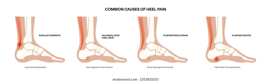 Common cause of heel pain. Ankle and foot diseases types diagram. Calcaneal spur, achilles tendinitis, plantar fascia strain, fasciitis treatment. Ankle bones and ligament medical vector illustration