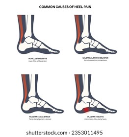 Common cause of heel pain. Ankle and foot diseases types diagram. Calcaneal spur, achilles tendinitis, plantar fascia strain, fasciitis treatment. Ankle bones and ligament medical vector illustration