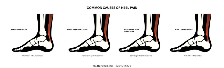Common cause of heel pain. Ankle and foot diseases types diagram. Calcaneal spur, achilles tendinitis, plantar fascia strain, fasciitis treatment. Ankle bones and ligament medical vector illustration