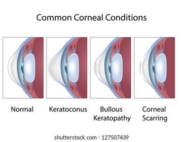 Common corneal conditions