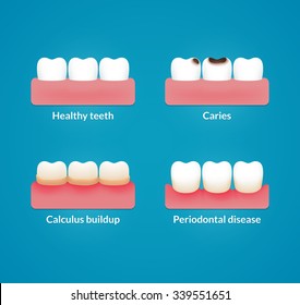 Common dental problems: caries, plaque and gum disease, with healthy teeth for comparison. Modern medical infographic chart. Vector illustration.