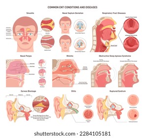 Enfermedades frecuentes de ENT. Nariz, garganta y oídos infecciones bacterianas, trastornos y afecciones. Problemas respiratorios de salud de órganos. Ilustración vectorial plana