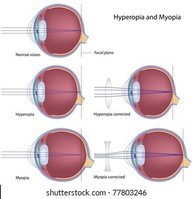  Common Eye Defects : Myopia And Hyperopia