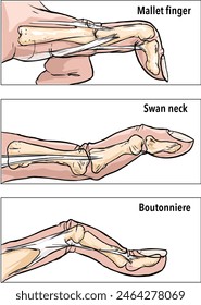 Common Finger Injuries vector illustration