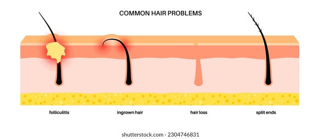 Common hair problems. Folliculitis, ingrown hair, split ends and baldness. Skin layers diagram, epidermis, dermis and hypodermis, subcutaneous fat, medical poster flat vector illustration