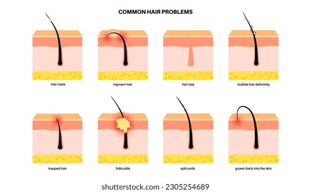 Common hair problems. Folliculitis, ingrown hair, split ends and baldness. Skin layers diagram, epidermis, dermis and hypodermis, subcutaneous fat, hair casts, medical poster flat vector illustration