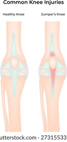 Common Knee Injuries Healthy vs Jumper's Knee Comparison Vector Illustration