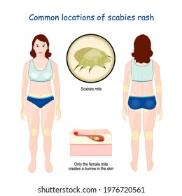 Common locations of scabies rash. Close-up of Scabies mite. Magnification of cross section of skin layers. female mite that creates a burrow in the skin. infographic. Vector illustration