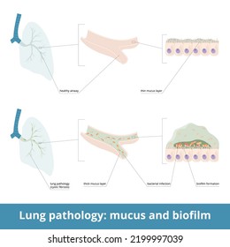 Common Lung Pathology And Excessive Mucus. Diseases (cystic Fibrosis) May Cause The Formation Of Thick Mucus In Airways, Bacterial Infection. Biofilm Formation In The Lungs.