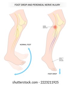 Vista lateral de la anatomía dorsiflexión de pie y pierna en la medicina