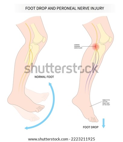 common tibial fibular pain with ankle trauma lower leg atrophy muscle lift loss knee sciatic nerve injury of feet drop palsy and spinal cord test spine damage brain Stroke flex deep Neck bone cervical Stock photo © 