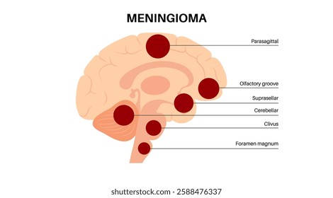 Common type of meningiomas cancer in the human skull. Tumor on the membranes that surround the brain and spinal cord. Meninges inflammation concept. Neoplasm in the head ct or mri vector illustration