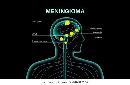 Common type of meningiomas cancer in the human skull. Tumor on the membranes that surround the brain and spinal cord. Meninges inflammation concept. Neoplasm in the head ct or mri vector illustration