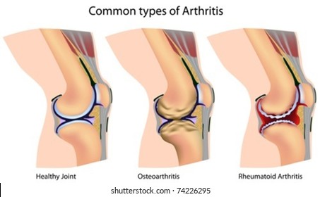 Common types of arthritis