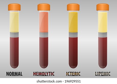 Common Types Of Blood Serum Sample Errors