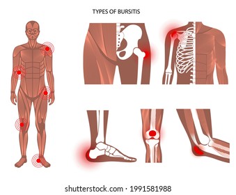 Tipos comunes de bursitis. Bursa inflamada en el cuerpo humano. Codo, hombro, dolor de rodilla. Inflamación de la cadera y el pie de la aguja. Concepto de tratamiento e inyección. Afiche anatómico gráfico de vector médico plano