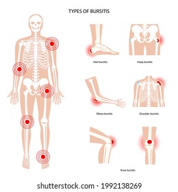 Common types of bursitis. Inflamed bursa in human body. Elbow, shoulder, knee pain. Ankle hip and foot inflammation. Treatment and injection concept. Anatomical poster flat medical vector illustration