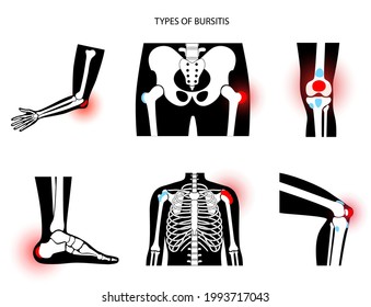 Common types of bursitis. Inflamed bursa in human body. Elbow, shoulder, knee pain. Ankle hip and foot inflammation. Treatment and injection concept. Anatomical poster flat medical vector illustration