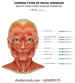 Common types of facial wrinkles treatment, male model face muscles detailed anatomy, beauty injections treatment areas info poster.