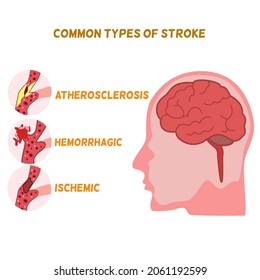 Common types of stroke, atherosclerosis, hemorrhage, ischemic , a head with brain on white background 