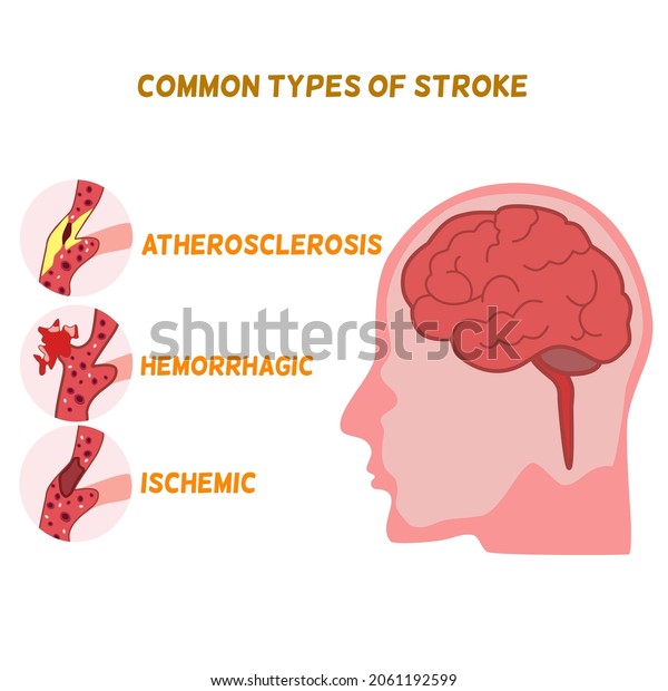 Common Types Stroke Atherosclerosis Hemorrhage Ischemic Stock Vector ...