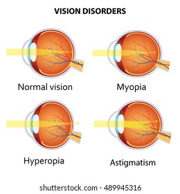 Common vision disorders. Astigmatism, Myopia and Hyperopia