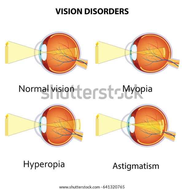Common vision disorders. Astigmatism, Myopia\
and Hyperopia
