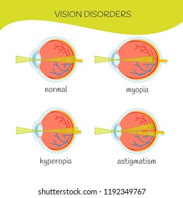 Common vision disorders. Normal, hyperopia, myopia, astigmatism.