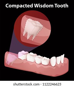 Compacted Wisdom Tooth Diagram illustration