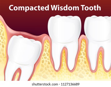 Compacted Wisdom Tooth Diagram illustration