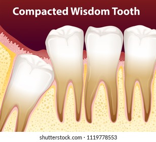 A compacted wisdom tooth illustration