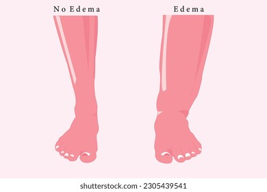 comparation of normal foot and edema foot, set of flat illustration for education. eps 10