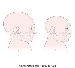 Comparative anatomical image of the head and skull of a newborn child with a normal cranium and with microcephaly. The virus of Zika. Vector. Isolated on white background
