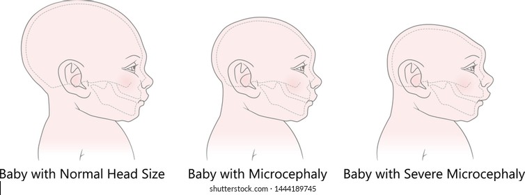 Comparative anatomical image of the head and skull of a newborn child with a normal cranium and with microcephaly and severe microcephaly. Virus of Zika. Vector. Isolated on white background